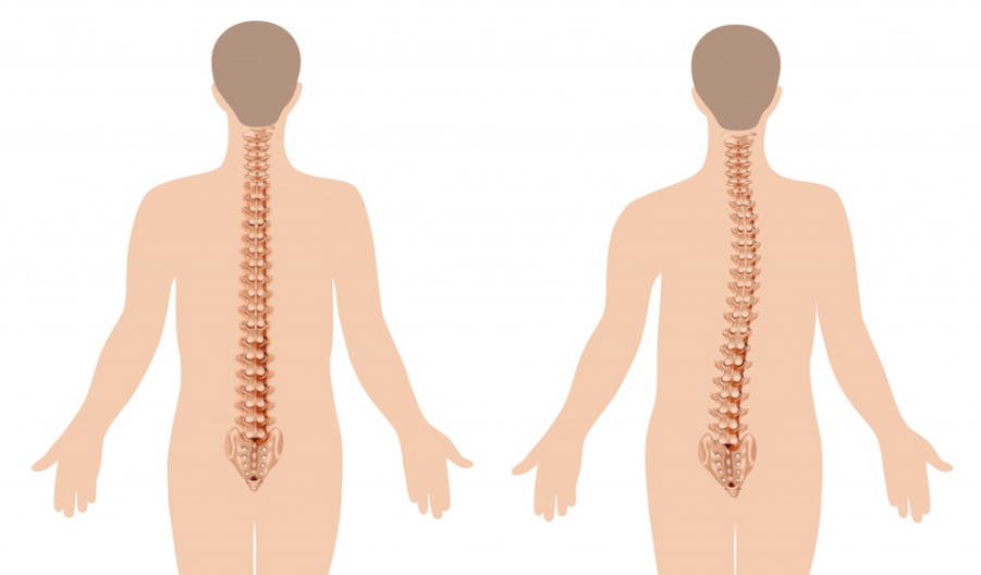 manifestare a osteocondrozei