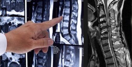 Diagnosticul durerilor de spate