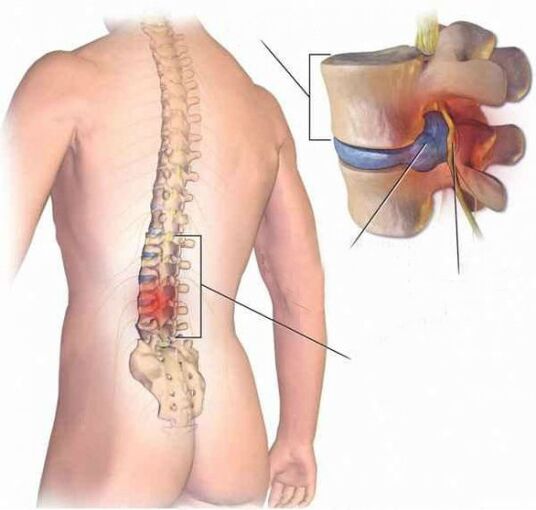 Hernie intervertebrală